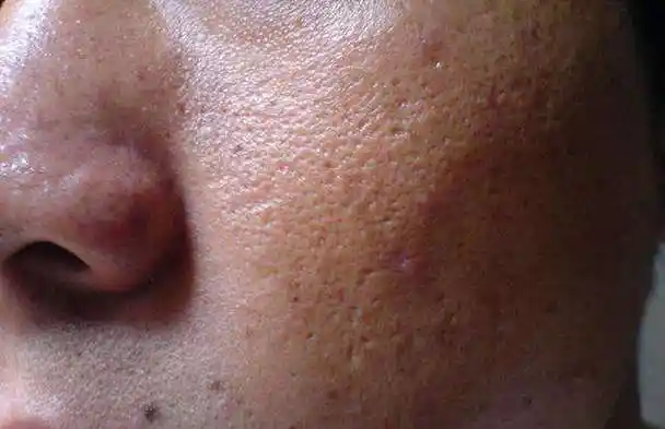 保湿,防晒,抗衰老4出油型毛孔皮肤毛孔t字区呈现u型扩张,肌肤油光粗大