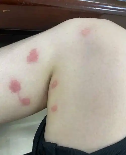 跳蚤咬的包和疤痕多久能消下去跳蚤咬的红疙瘩图片