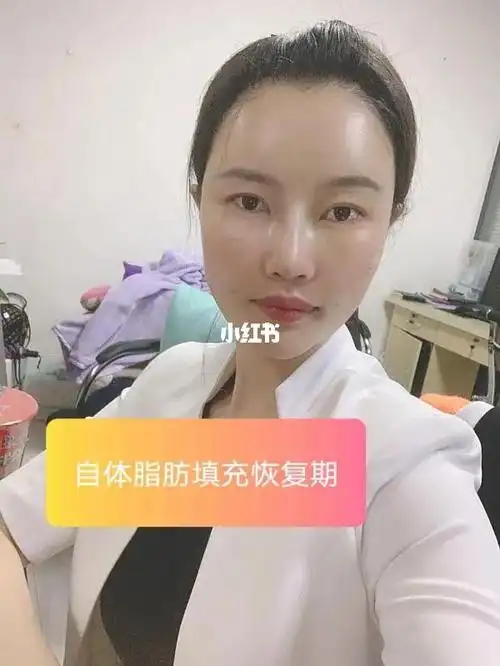 刚做了脂肪填充,这么肿还是有点慌_脂肪填充_消肿_美妆_医美整形