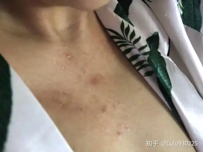 胸前毛囊炎用阿达帕林治疗几天成这样能好吗