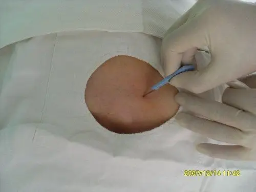 切开穿刺点皮肤皮下.