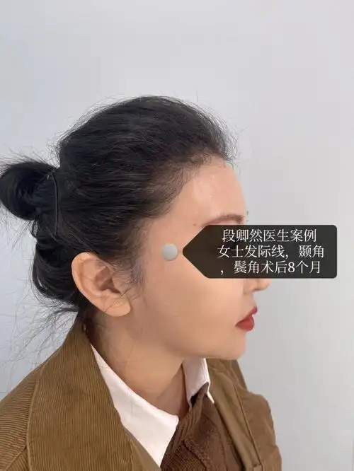 女士植发发际线颞角鬓角术后8个月
