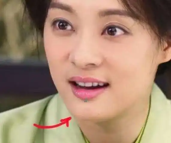 孙俪下巴的痣怎么回事 为什么名人的痣都不愿意去(2)