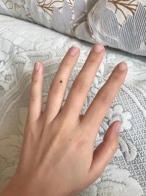 本人女左手无名指半年前多新长了一颗痣 有什么寓意? - 知乎
