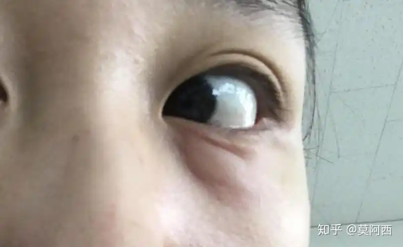 下眼袋突然肿起来是什么回事?