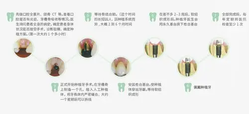 种植牙步骤