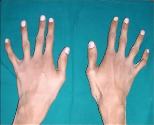 好着急!马凡氏综合症"医院助孕"-第2张图片-楠楠博客