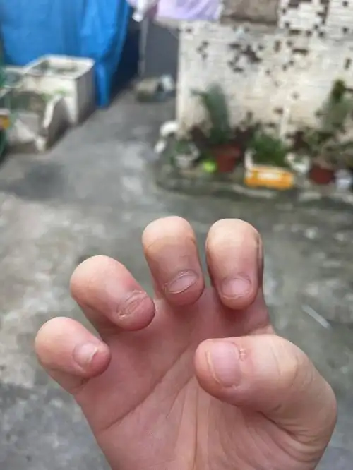 关于啃指甲的那些事