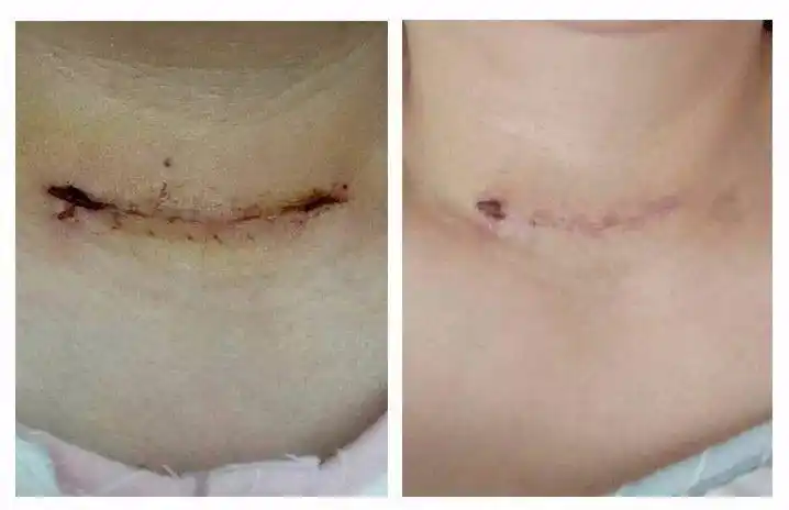 左图为使用前,右图为使用后(5天)