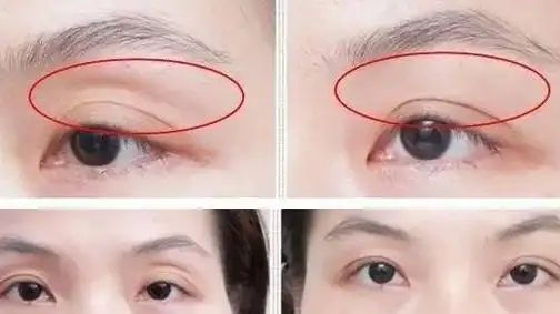 脂肪填充眼窝风险大不大?杭州填充眼窝好的医生有哪些? - 知乎