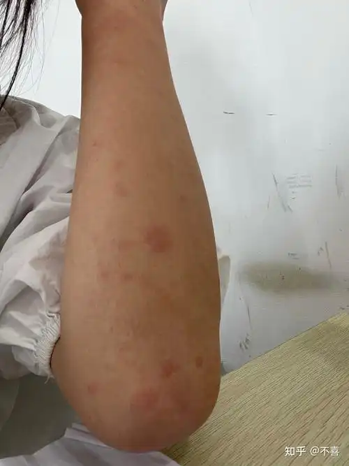 寒冷性荨麻疹你们冬天怎么过