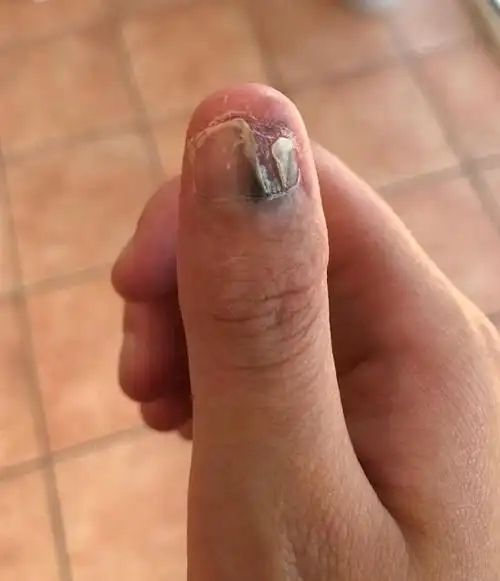 爱咬指甲,咬到被截肢!这个习惯必须改!会要命!