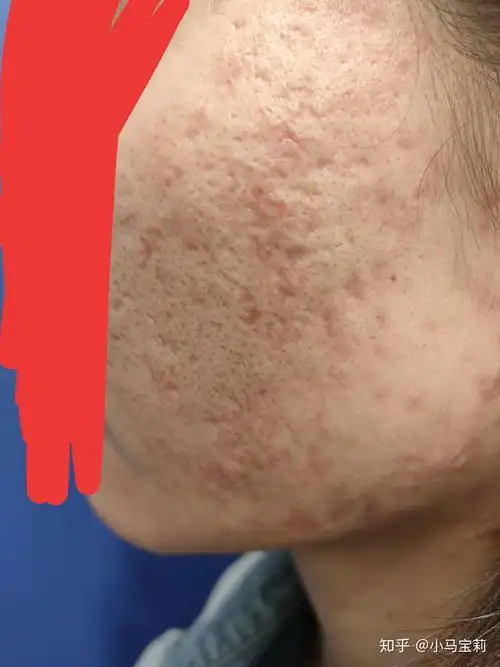 治疗痘坑 - 知乎