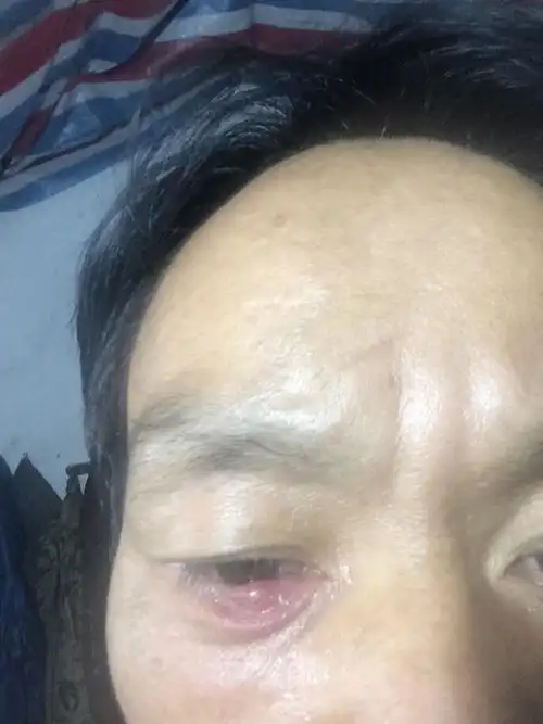 展开全部 发图看下,是眼睑发炎还是皮疹,才可以分析建议