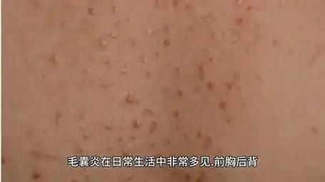 要注意,毛囊炎会造成哪些影响