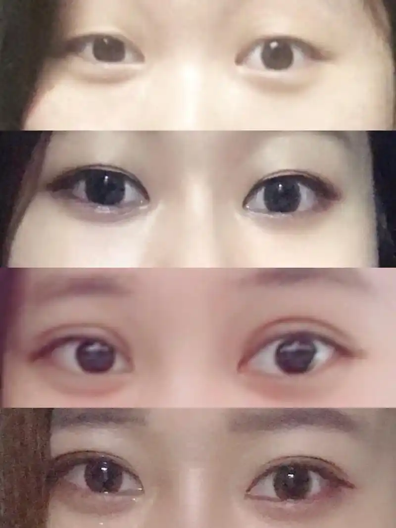 全切双眼皮 上眼睑肌无力矫正 图片顺序分别是:单眼皮双眼皮贴术后不