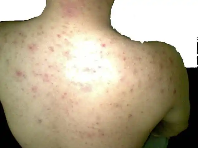 阴茎长毛囊炎的症状图片