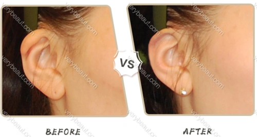 折叠耳矫正