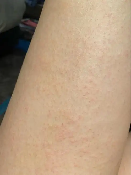 寻麻疹,全身过敏…实在忍不住了去诊所准备挂针,医师拿着类似电筒一样