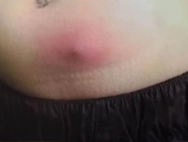 前胸后背,头皮反复长红疙瘩,小心是毛囊炎作祟_澎湃号