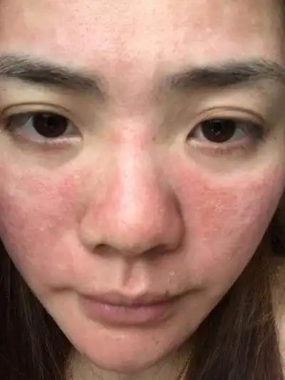 化妆品过敏症状图片48