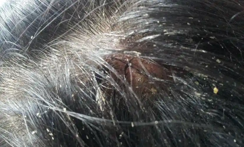 头皮真菌感染头癣图片宝宝头上的头癣的图片宝宝头上的头癣图片白癣