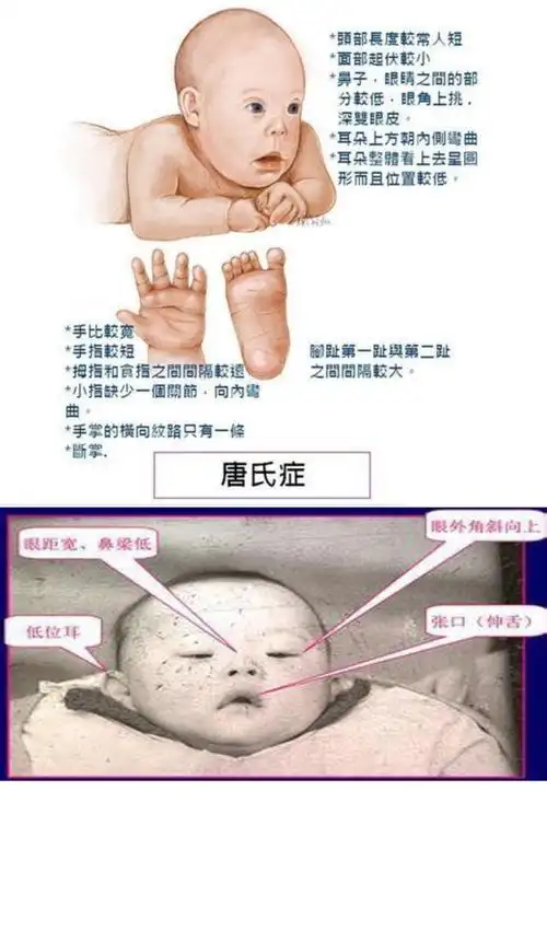 唐氏综合征筛查您了解多少?