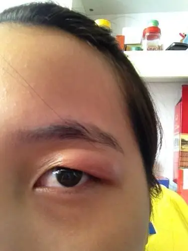 眼睛红肿的原因