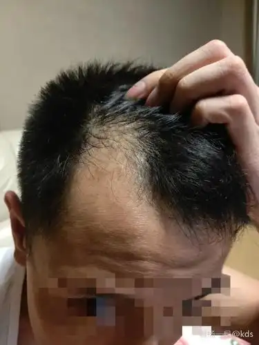 30岁,两额头发已经秃成这样,怎么办?