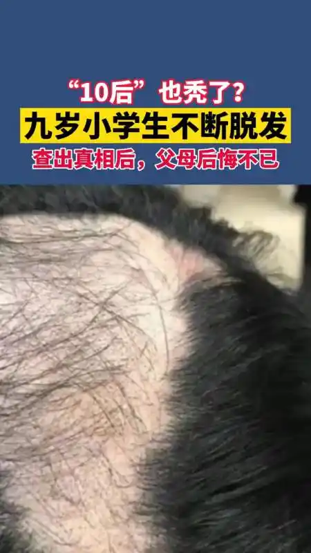 九岁小学生不断脱发,患上"拔毛癖"