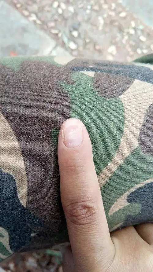 我的指甲一层一层的脱掉是怎么回事呀,好恐怖哇