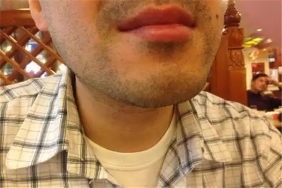 胡子长得快每天都得刮是什么情况对男人来说这是正常的吗