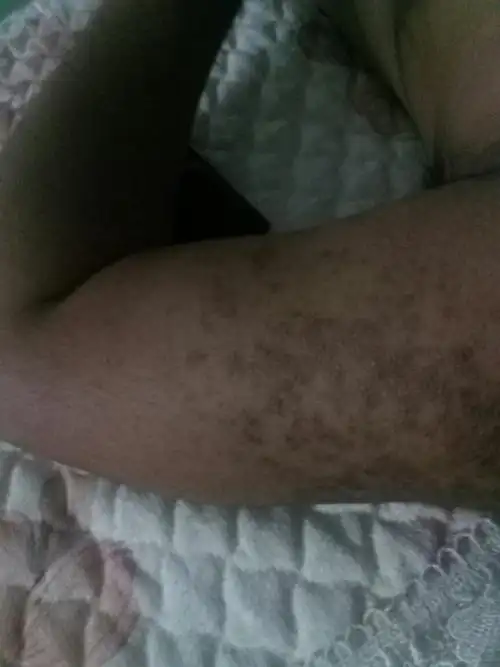 胳膊上长的褐色斑点,10几年了不痛不痒,没任何不适就是影响美观.