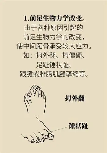 前脚掌起老茧一踩地就疼痛?当心这可能是跖痛症