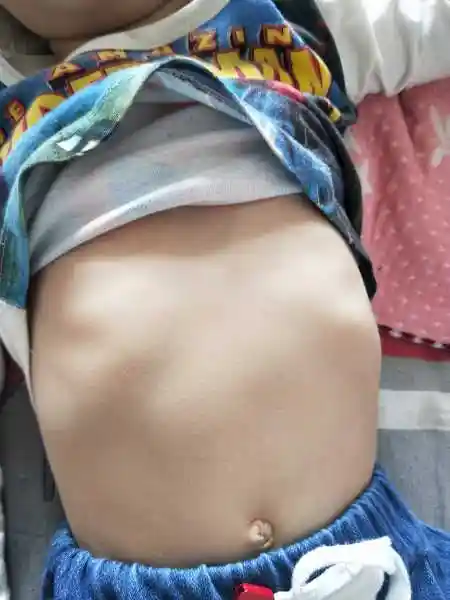 是不是佝偻病_百度知道