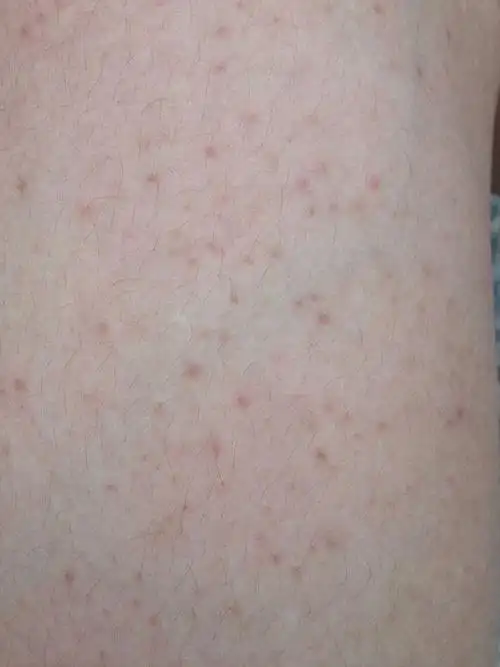 大腿上有很多小红点