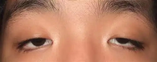 做手术吗上睑下垂怎么做的上睑下垂修复术把眼睛变大恢复需要多长时间