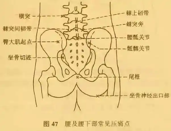 请看上图),这一些位置的疼痛使得原本紧张的腰椎更加紧张,腰部会产生