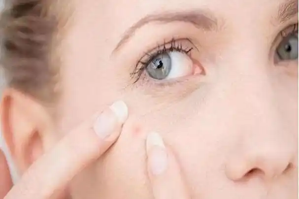 红霉素软膏涂抹眼下有什么作用(红霉素软膏在眼部涂两下)(3)