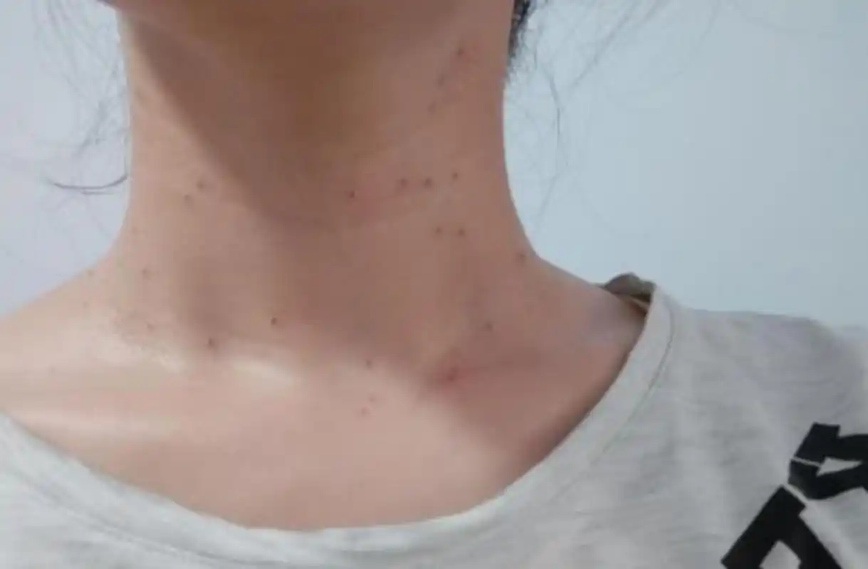 脖子长长了一些小揪揪 这叫丝状疣,是一种病毒感染引起的皮肤病 记住,