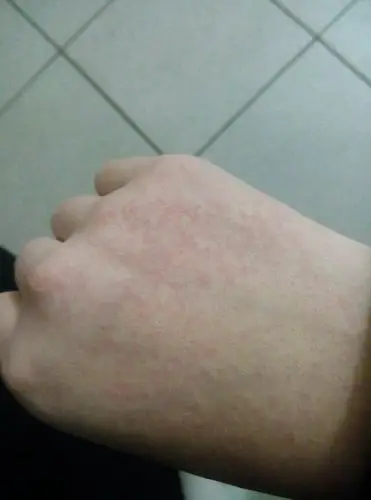 手背过敏了怎么办?我在老年人头发护理店上班.