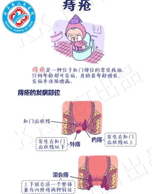 有"籽"难言:痔疮发作怎么办?