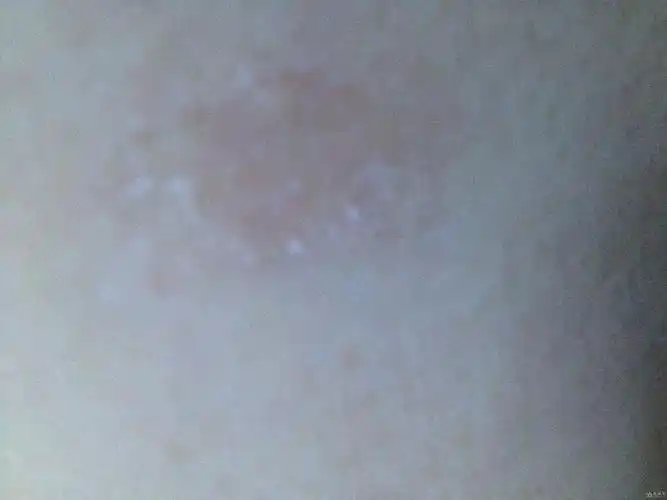 请各位老师帮忙看看这个是什么癣,有图的 - 中医皮肤版 - 爱爱医医学