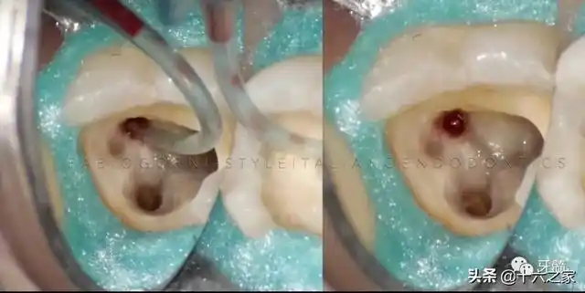 下颌第二磨牙罕见病例及其处理