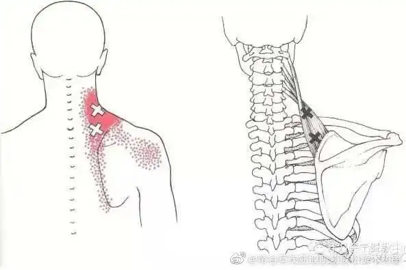 头颈部--肩胛提肌肌筋膜疼痛触发点