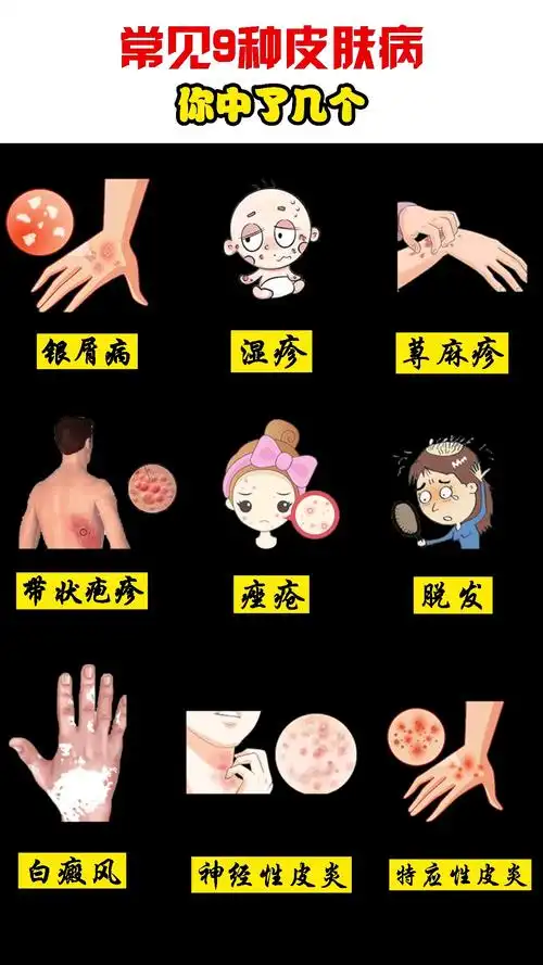 皮肤常见九种皮肤病您中了几个留言告诉我