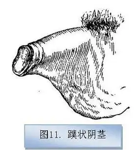 男性生殖器畸形及疾病治疗之3—蹼状阴茎及阴茎阴囊转位