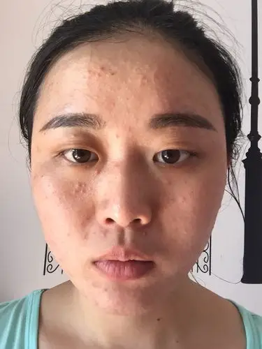 我脸上最近长了好多痘痘,满脸都长.