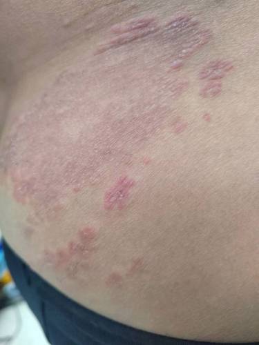 00折后价￥98老年人秋冬皮肤瘙痒干燥屁股痒全身湿痒止痒膏特效成人