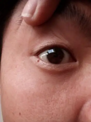 的 会看面相的 或者是医学的,帮我看看我右眼下眼皮靠右边的这颗痣,是